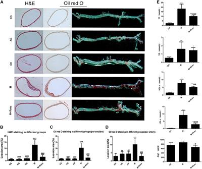 Pyk2/MCU Pathway as a New Target for Reversing Atherosclerosis